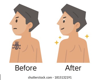 Before And After Tattoo Removal