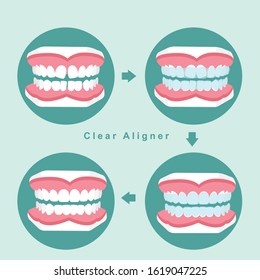 before and after of teeth with orthodontic braces , clear aligner ,vector illustration.
