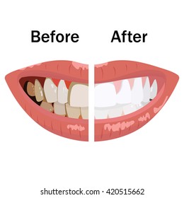 Before and after teeth whitening on withe background.