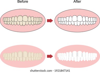 Before and after teeth with whitening treatment