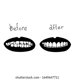 Before and after transformation process. Braces alignment progress, teeth changing form. Vector stock illustration in doodle style. 