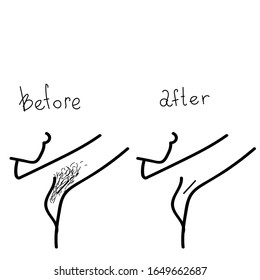 Before and after transformation process. Woman beauty procedures, shaving of armpits, laser hair removal. Vector stock illustration in doodle style.