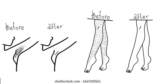 Antes y después del proceso de transformación. Procedimientos de belleza para mujeres, afeitado de axilas, depilación láser. Conjunto vectorial de ilustraciones en forma de doodle.