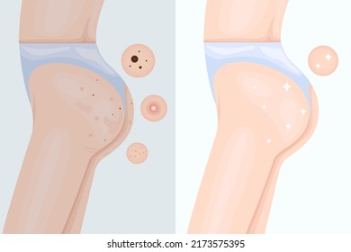 Before and after treating acne on the buttocks