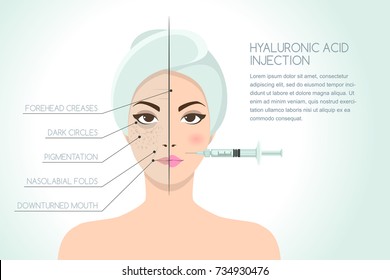 Before and after vector illustration of woman having hyaluronic acid facial injection. Vector infographics design template. Beauty, cosmetology, anti-aging concept.