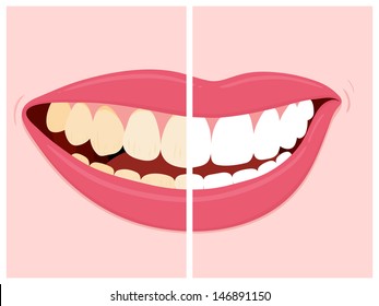 Before and after view of teeth whitening