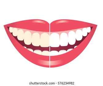 before and after whitening teeth isolated on white background/whitening teeth