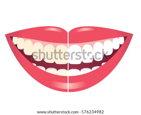 before and after whitening teeth isolated on white background/whitening teeth