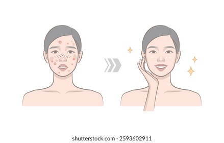 Before and after of woman character with skin trouble as pimple, blackhead, whitehead, zit, blemish, acne, freckle, papule and woman with clear and clean skin. Portrait of cosmetic female model.