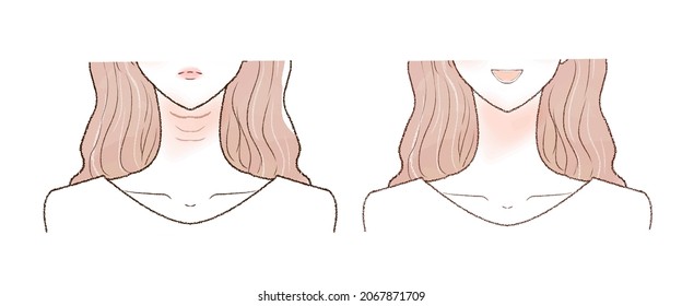 Before and after of a woman suffering from wrinkles in the neck. On white background.