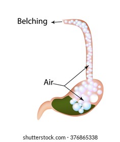 Belching. Air in the stomach. The structure of the esophagus and stomach. Infographics. Vector illustration.