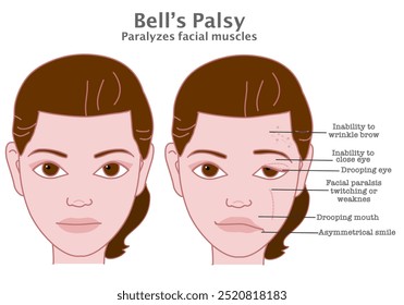 Bell palsy. Facial muscle paralysis. Drooping, close eyes, twitching weakness causes. asymmetric woman face, smile. Medical illustration vector	