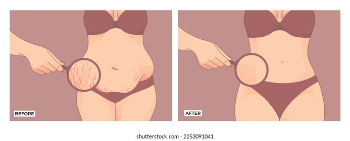 Belly fat. Before and after weight loss, woman body shape transformation, Fat To Fit. 