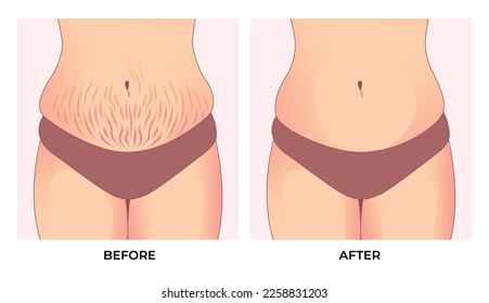 Belly fat. Before and after weight loss, woman body shape transformation, Fat To Fit. 