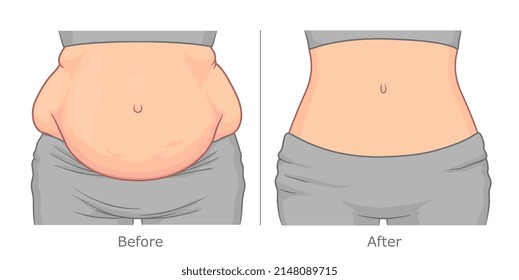 Belly fat loss illustration. Woman's belly before and after weight loss. 