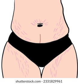 Belly con marcas de estiramiento. Huelga después del embarazo. Cintura y piernas con sobrepeso. Cuerpo posparto en vector. Mujer con grasa en ropa interior negra.