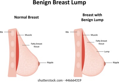 painful lump in breast