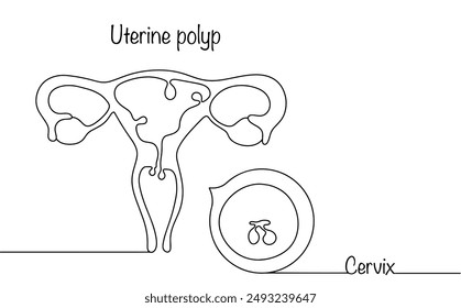 Una formación benigna que se extiende por toda la cavidad uterina como resultado del crecimiento excesivo de su membrana mucosa. Pólipos trazados con una línea simple en el área del útero y el cuello uterino.