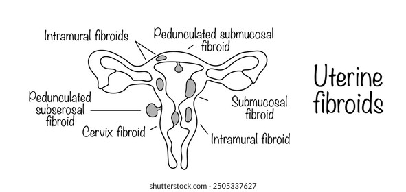 A benign hormone-dependent formation that develops from the muscle and connective cells of the uterus. Medical vector.