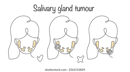 Benign, malignant and intermediate tumors originating from the tissues of the salivary glands. Drawn human salivary glands and tumors on some of them. Hand drawn vector.