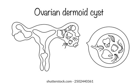 A benign neoplasm formed from the rudiments of intrauterine elements. Ovarian cyst with rudiments of teeth, nails and hair. Medical vector.