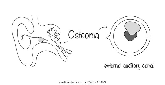 Neoplasia benigna que cresce a partir da parte óssea do canal auditivo externo. Uma doença que leva à deterioração gradual da audição. Ilustração de vetor médico.