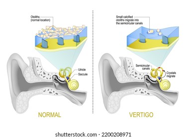 Benign Paroxysmal Positional Vertigo Bppv Labyrinth Stock Vector ...