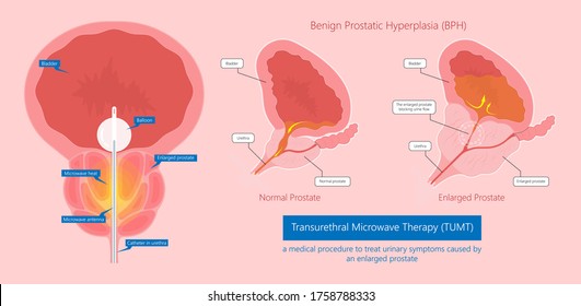 Prostatitis és kezelés diagram