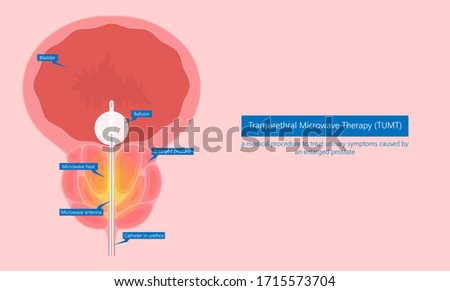 Benign prostate enlargement Prostatitis of BPH the UTI exam flow pain tube TUMT TURP Acute block fluid gland penis sperm tract treat urine benign cancer pelvic system