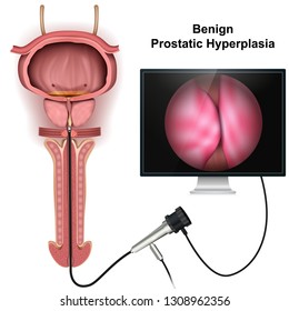 Benign prostatic hyperplasia 3d medical vector illustration on white background