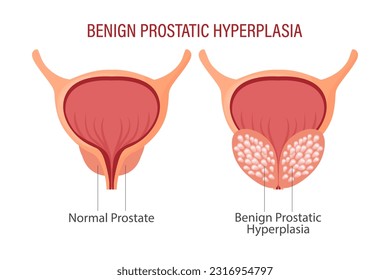 Benign prostatic hyperplasia. Anatomy of human organs. Medicine, healthcare and science concept. Education infographics banner