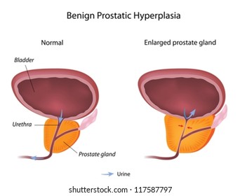 Benign Prostatic Hyperplasia (BPH)