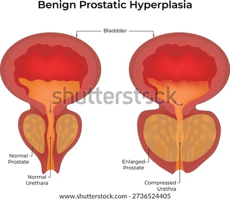 Benign Prostatic Hyperplasia BPH Comparison Normal vs Enlarged Prostate