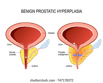 Benign Prostatic Hyperplasia (BPH). Prostate Enlargement. Diagram Of A Normal Prostate And Prostatitis