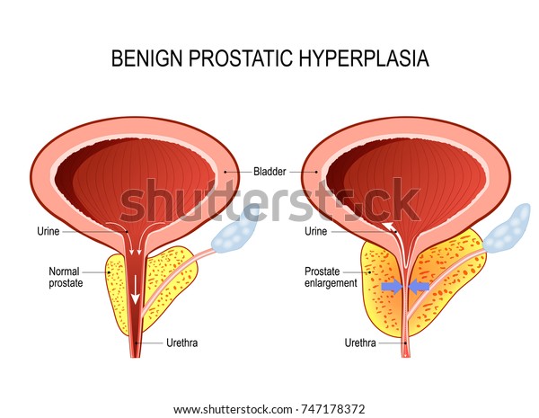 prostatitis hiperplázia