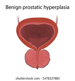 Benign prostatic hyperplasia, enlarged prostate. Realistic vector medical illustration.