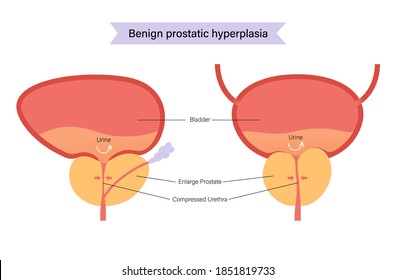 Logo benigno de hiperplasia prostática para clínica. Problema de vejiga normal y BPH. Dolor en el concepto del sistema reproductivo masculino. Órganos internos humanos, glándula prostática, anatomía de vejiga e ilustración vectorial plana.