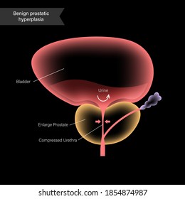 Benign Prostatic Hyperplasia Logo For Clinic. BPH Problem Concept. Pain In Male Reproductive System. Human Internal Organs, Prostate Gland And Bladder Anatomy. Xray 3D Realistic Vector Illustration.