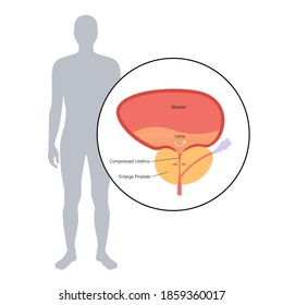 Logo benigno de hiperplasia prostática para clínica. Dolor en el sistema reproductivo masculino. Concepto de problema de la glándula próstata. Órganos internos y anatomía de vejiga. Afiche médico de información de BPH. Ilustración vectorial plana.