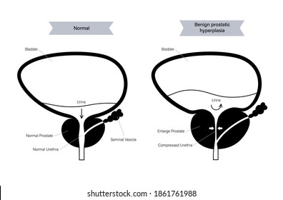 Benignes Logo der Prostatahyperplasie für die Klinik. Normale Blasenentleerung und BPH-Problem. Schmerzen im Konzept des männlichen Fortpflanzungssystems. Menschliche innere Organe, Prostatadrüse, Blase anatomie flache Vektorgrafik.