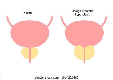 Logo benigno de hiperplasia prostática para clínica. Problema de vejiga normal y BPH. Dolor en el concepto del sistema reproductivo masculino. Órganos internos humanos, glándula prostática, anatomía de vejiga e ilustración vectorial plana.