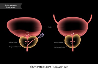 Benign Prostatic Hyperplasia Logo For Clinic. Normal Bladder And BPH Problem. Pain In Male Reproductive System. Human Internal Organs, Prostate Gland Anatomy. Xray 3D Realistic Vector Illustration.