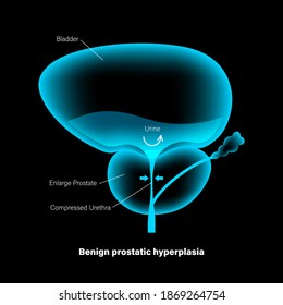 Benign Prostatic Hyperplasia Logo For Clinic. BPH Problem Concept. Pain In Male Reproductive System. Human Internal Organs, Prostate Gland And Bladder Anatomy. Xray 3D Realistic Vector Illustration.