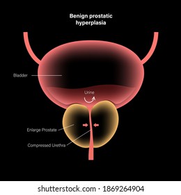 Benign Prostatic Hyperplasia Logo For Clinic. BPH Problem Concept. Pain In Male Reproductive System. Human Internal Organs, Prostate Gland And Bladder Anatomy. Xray 3D Realistic Vector Illustration.