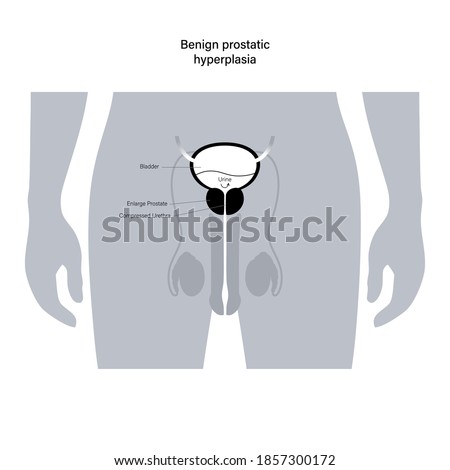 Benign prostatic hyperplasia logo for clinic. Male reproductive system concept. Prostate gland, bladder and testicle anatomy in human silhouette. Internal organs in man body flat vector illustration.