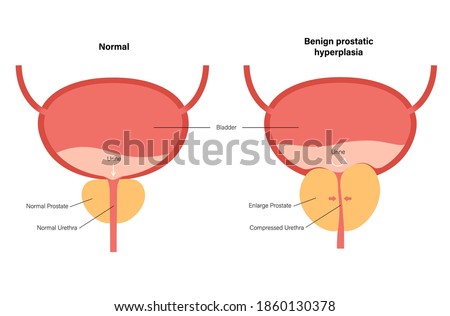 Benign prostatic hyperplasia logo for clinic. Normal bladder and BPH problem. Pain in male reproductive system concept. Human internal organs, prostate gland, bladder anatomy flat vector illustration.