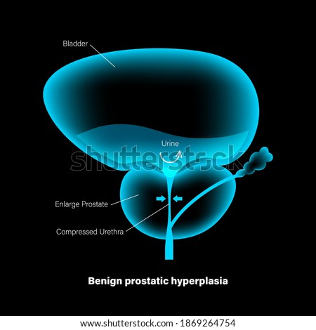 Benign prostatic hyperplasia logo for clinic. BPH problem concept. Pain in male reproductive system. Human internal organs, prostate gland and bladder anatomy. Xray 3D realistic vector illustration.
