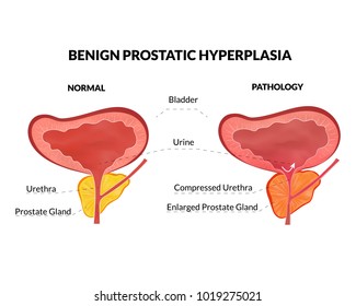 Benign Prostatic Hyperplasia Non Lethal Pathology Stock Vector (Royalty ...