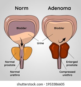 Prostate Hyperplasia csomó)