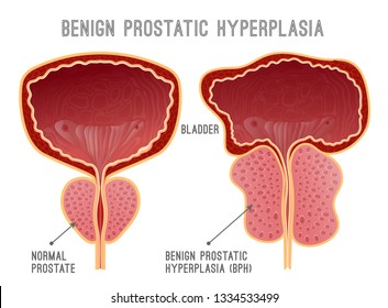 Benign Prostatic Hyperplasia. Prostate Disease Infographic. Urology Medical Image With Urinary Bladder. Editable Vector Illustration In Realistic Style  Isolated On White Background.